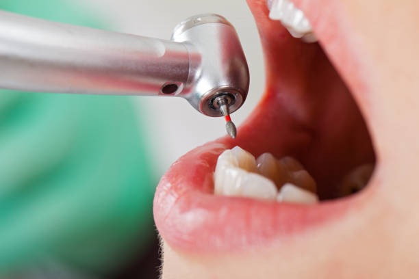 Best Emergency Root Canal Treatment in Texarkana, TX